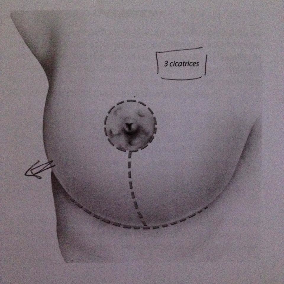 La réduction mammaire, explications :)